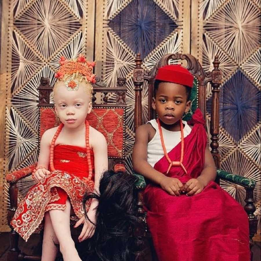 albino twins