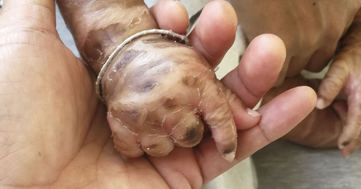 a hand displaying features of Harlequin Ichthyosis