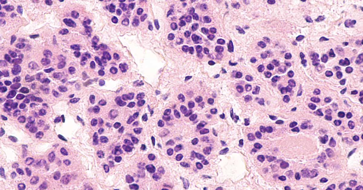 Microscopic image of an adrenal cortical adenoma, a benign tumor of the adrenal gland